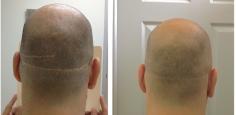 SMP for hair transplant scars