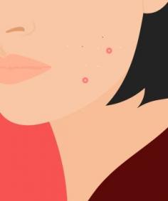 
                    
                        What you need to know about your acne — gross, but true
                    
                