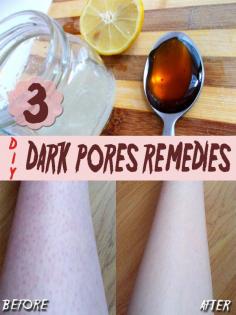 2.HOMEMADE REMEDIES FOR DARK PORES !