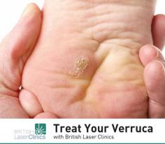 Want to get rid of your verrucas? Visit British Laser Clinics. We will use a cryotherapy procedure as it is a great method for treating stubborn warts and verrucas.
