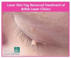 Skin Tag is like a small piece of hanging skin, occur on the under the breasts, eyelids or neck. British Laser Clinics provides best laser skin tag removal treatment at affordable prices.