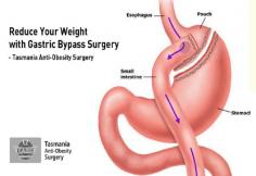 Get in touch with Tasmania Anti-Obesity Surgery for getting the weight loss treatment like gastric bypass surgery. This operation is best for the person who likes sweets and also in this procedure, more weight is reduced as compared to gastric band. So call us today and book your appointment.
