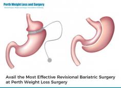 Revisional bariatric surgery is a treatment for those patients who have already received a bariatric treatment previously & want revisional surgery due to gaining weight again or complications in previous surgery. At Perth Weight Loss Surgery, we provide Revisional bariatric surgery with our experienced team. Get in touch with us today if you also want the surgery. 