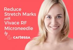 Diminish your stretch marks with Vivace RF Microneedle provided by Cartessa Aesthetics. This device will increase collagen and further strengthen skin with minimal discomfort. For more details, contact us now! 