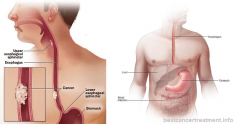 Esophageal Cancer - Types, Symptoms, Causes, Stages, Treatment