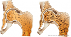 Bone Cancer - Types, Symptoms, Causes, Stages, Treatment