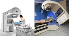 Radiation Therapy for Cancer. Advantages & Side effects