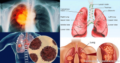 Lung cancer Symptoms, Causes, Stages and Treatment