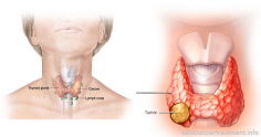 Thyroid Cancer - Types, Symptoms, Causes, Stages, Treatment
