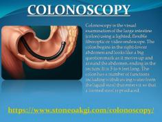 Colonoscopy is the visual examination of the large intestine (colon) using a lighted, flexible fiberoptic or video endoscope. The colon begins in the right-lower abdomen and looks like a big question mark as it moves up and around the abdomen, ending in the rectum. It is 5 to 6 feet long. The colon has a number of functions including withdrawing water from the liquid stool that enters it so that a formed stool is produced.