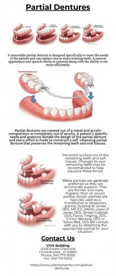 A removable partial denture is designed specifically to meet the needs of the patient and can replace one or more missing teeth. A natural appearance and speech clarity is restored along with the ability to eat more efficiently.