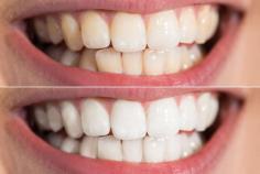 Need teeth whitening service in Lithonia? Then you are at the right place. Dental Touch Atlanta uses modern techniques and advanced equipment to help you get your beautiful smile back! Give us a call today at 404-973-2377 to book an appointment.
http://www.dentaltouchatlanta.com/teeth-whitening-lithonia/