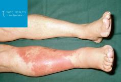 Cellulitis is a bacterial infection of the skin that tends to occur on the lower legs and in areas that are damaged or inflamed. Safe Health Dermatology in Mt. Pleasant and East Lansing explains causes, symptoms, treatment, and prevention. Browse our website for more information. 