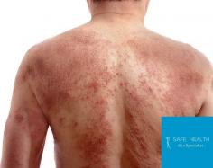 At Safe Health, dermatologists provide treatment for several types of eczema skin conditions: atopic & contact dermatitis, dyshidrotic & nummular eczema. Our dermatology specialists in Mt Pleasant provide word-class eczema treatment. If you are suffering from itchy eczema contact the dermatology clinic today. 