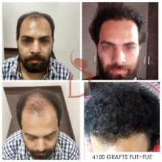 Are you looking for hair transplant surgery? See these amazing results who got 100 natural hair and he is extremely happy with his result. Dr. Amit Gupta and his plastic surgeon team are done his procedure. Dr. Amit Gupta is India's most trusted plastic surgeon.
Book your appointment on 9811994417 and visit on https://www.divinecosmeticsurgery.com/best-hair-transplant-doctor-cost-delhi.php