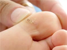Warts can seemingly appear out of nowhere, and your initial thought might be to perform a Google search to get some easy and quick remedies. Instead of finding something simple, you come across strange ideas, such as using bleach, baking powder, pineapple juice, apple cider vinegar, basil, and even toothpaste on your warts. Many wart removal specialists recommend the following 3 remedies for wart removal that actually works: 