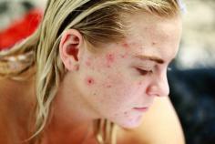 Get customized, effective and long term acne treatment by Our World Class Dermatologist in Lansing & Mt. Pleasant. Call us on 517-220-7546 for more information about our acne treatment.