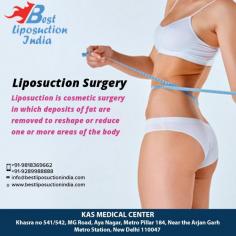 Tired of stubborn fat? Liposuction commonly referred to as body contouring or lipoplasty is a surgical procedure to permanently remove stubborn body fat in areas that are unresponsive to diet and exercise.
For more info visit www.bestliposuctionindia.com or call now on 9958221983 to book your consultation.
Now New Address: Khasra no 541/542, MG Road, Aya Nagar, Metro Pillar 184, Near the Arjan Garh Metro Station, New Delhi 110047 (India)
#liposuction #vaserliposuction #bodyjetliposuction #cosmeticsurgery #plasticsurgeon #bodycontouring #Delhi #India #drkashyap
