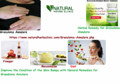 Diet plays a vital role in Natural Remedies for Granuloma Annulare. Avoid eating sweets and fatty food. Eat rich in minerals healthy diet, fibers, and vitamins.