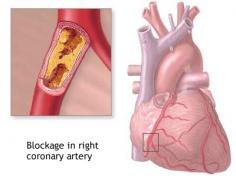 Treatment of Right Coronary Artery Blockage in Ayurveda with Herbal Remedies

RCA blockage or Right coronary artery blockage is a serious medical condition where occurs blockage in one of the main artery supplying to the heart, i.e. Right coronary artery. This blockage is resulted due to the building up of atherosclerotic plaque in the arteries. Plaque causes the narrowing of the artery resulting in blockage of blood flow through it.