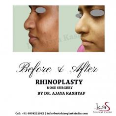 KAS Medical Center has highly qualified and experienced Rhinoplasty surgeon that have done success nose jobs in Delhi, India. Get a consultation! 
Visit:https://www.bestrhinoplastyindia.com
To schedule an appointment please call +91-9958221982
Now New Address: Khasra no 541/542, MG Road, Aya Nagar, Metro Pillar 184, Near the Arjan Garh Metro Station, New Delhi 110047 (India)
#rhinoplasty #rhinoplastyindelhi #nosejobindia #beforeandafter #cosmeticsurgery #rhinoplastysurgerydelhi
