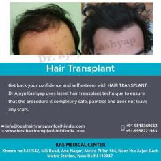 Get back your confidence and self esteem with #HAIRTRANSPLANT. Dr. Ajaya Kashyap uses latest hair transplant technique to ensure that the procedure is copletely safe, painless and does not leave any scars.

======

For further information regarding HAIR TRANSPLANT, please visit our website at www.besthairtransplantdelhiindia.com or write to us at info@besthairtransplantdelhiindia.com

======

Call / Whatsapp TODAY - 91 9818369662, 9958221982, 9958221981

#FUEHairTransplant #HairTransplantation #HairTreatment #Eyebrow #Eyelash #Beard #Moustaches #CosmeticSurgery #CosmeticSurgeon #PlasticSurgery #PlasticSurgeon #MedSpa #DrAjayaKashyap #DrKashyap
