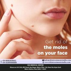 Do you know that unwanted moles can be removed with out a scar!
Yes it is possible now with the laser mole removing procedure at KAS Medical Center.
Schedule Your Consultation Today! +91-9818369662, 9818300892
Whatsapp direct link:
https://api.whatsapp.com/send?phone=919818300892
Email: info@skintreatmentsindia.com
Now New Address: Khasra no 541/542, MG Road, Aya Nagar, Metro Pillar 184, Near the Arjan Garh Metro Station, New Delhi 110047 (India)
#MoleRemoval #SkinTreatments #Lasers #Warts #Moles #Keloids #Beautiful #Face #Body #DrKashyap #Clinic #SouthDelhi #Low #Cost
