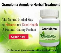 Common Natural Remedies for Granuloma Annulare comprises apple cider vinegar use topically and taken orally, DMSO, tannic acid, milk of lysine, and magnesia.