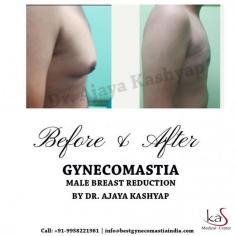 Some men can develop excess breast tissue on one or both sides that can be corrected with various techniques including liposuction and excision of the breast tissue directly.
Dr. Ajaya Kashyap more than 30 years of experience and qualifications being a Triple American Board certified plastic surgeon allows him to deliver the best cosmetic surgery at affordable cost in Delhi.
For more info visit www.bestgynecomastiaindia.com or call now on 9958221981 to book your consultation.
#gynecomastia #malebreastreduction #gynecomasiasurgeon #cosmeticsurgeryclinic #plasticsurgeonindia #bestgynecomastiaindia

