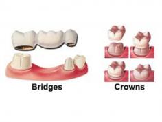 Looking for best crown bridge Centre and Clinic in Thoraipakkam, Navalur, OMR, Perungudi, Siruseri Chennai?. Rootz Dental Care is the Best crown bridge Centre and Clinic in Thoraipakkam and Navalur Chennai.

http://rootzdentalcare.in/crown-bridge.php

