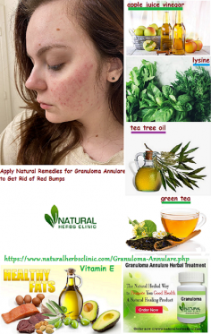 There is a number of Natural Remedies for Granuloma Annulare incorporates DMSO, apple juice vinegar associated topically and taken orally, drain of magnesia, lysine, and tannic destructive.
