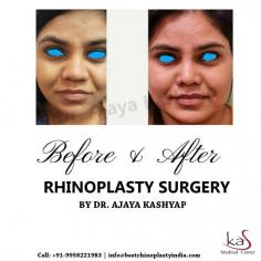 Unhappy with the shape or size of your Nose? Rhinoplasty can correct any flaw & reconstruct the nose to address any deformity or breathing issue.
Contact us anytime with any questions you may have, or to schedule your consultation for rhinoplasty surgery in Delhi, India.
CONTACT US:-
Dr. Ajaya Kashyap
WhatsApp:
https://api.whatsapp.com/send?phone=919958221982
Mobile: +91-9818369662, 9958221982
Web: www.bestrhinoplastyindia.com
#KasMedicalCenter #Delhi #India #rhinoplasty #nosesurgery #nosereshaping #smallnose #widenose #broadnose #nosejob #plasticsurgery #plasticsurgeon #cosmeticsurgery #cosmeticsurgeon #bestplasticsurgeon #topplasticsurgeon #aesthetician #medspa
