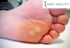 Warts can be small, painless growths of thick layers of skin caused by viruses. Warts are non-cancerous benign skin growths that occur when a virus invades the top layers of the skin. Call Safe Health & Med Spa to discuss a wart treatment plan to live a life with healthier skin. 