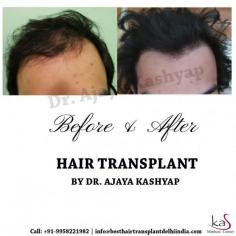 If you want a long term and permanent solution for your baldness, consider hair transplant surgery. 
EMI Available Pay Easy Monthly Instalments

For more information 
WhatsApp: https://api.whatsapp.com/send?phone=919289988888
Visit: www.besthairtransplantdelhiindia.com

#HairTransplant #FUE #FUT #HairLoss #PRP #Beard #Moustaches #Eyelash #Eyebrows #PlasticSurgery #Aesthetics #lifestyle #traveling #Hair #Travel #MedicalTourism #Men #Women
