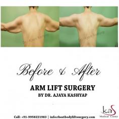 An Arm Lift, also known as Brachioplasty, reduces excess skin and fat between the underarm and the elbow, reshapes your arm to result in smoother skin and contours, and results in a more toned and proportionate appearance.

Contact us anytime with any questions you may have, or to schedule your consultation for arm lift surgery clinic in Delhi, India.

Dr. Ajaya Kashyap
Email: info@bestbodyliftsurgery.com
Web: https://www.bestbodyliftsurgery.com

#brachioplastycostindelhi #armliftsurgeryindelhi #cosmeticsurgeryindia #plasticsurgeonindia 
