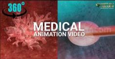 360° Panoramic interactive virtual tours of 3D Medical Animation by Virtual Reality Studio - Columbus, Ohio

Project: 360° Panoramic interactive VR (3D Anaglyph videos) | Cancer Tumour Treatment 
Client: 858. Sherri 
Location: Columbus, Ohio

Treatment Video: https://youtu.be/W1up8kMVH9s
For More: https://yantramstudio.com/medical-animation-outsourcing.html

Interactive 360° Medical VR ( Virtual Reality videos ) Animation (3D Anaglyph Video - Stereoscopic 3D Animation) - Bladder Cancer Tumor Treatment by medical animation Virtual Reality Studio. This video Image Synergo's product - catheter can cure bladder cancer tumor and its cells easily. This image is developed 360°, 3D anaglyph, 4K resolution can be seen in VR - Virtual Reality cardboard device and also wearing 3d glasses by. Virtual Reality Studio can develop any type of 3D Interactive VR Solution for many industries. As a virtual reality developer, our main expertise is virtual reality apps development and virtual reality application for Medical, Real Estate, Commercial Real Estate, etc. Virtual reality studio We are a creative technology studio specializing in highly immersive content and interactive applications. Virtual Reality is a Real-Time Process for all types of development hence it does not require post-production.  
