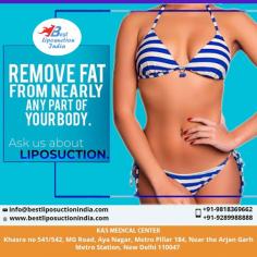 For people with stubborn fat pockets, liposuction can produce amazing outcomes. 
www.bestliposuctionindia.com

#liposuction #vaserliposuction #liposuctioncost #cosmeticsurgery #plasticsurgery #DrAjayaKashyap

