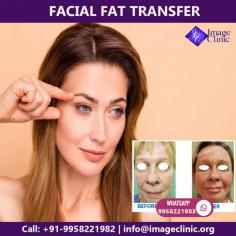 KAS medical Center has experienced surgeon and also have many years of experience in this field. If you are looking for the Facial Fat Transfer in Delhi then you can undoubtedly go with KAS medical Center.
To schedule an appointment please call +91-9958221982.
Visit: www.imageclinic.org
Book video call consultation please call/WhatsApp: +91-9958221983, 9958221982
#facialfattransfer #PRP #KASlift #cosmeticsurgeryclinic #plasticsurgeonindia #bestsurgeonindia
