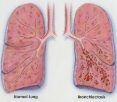 Bronchiectasis is a rare condition where the airways leading to the lungs become damaged. The result of bronchiectasis is enlargement of the bronchial tubes, loss of elasticity, scarring, and destruction of cilia instrumental in protecting the lungs from dust, bacteria, and excess mucus.