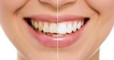Teeth Whitening in the Virgin Islands

At VI Dental Center, our team is prepared to answer all questions about teeth whitening. Oral hygiene, specifically brushing and flossing, are a vital part of your dental health. We can also answer your questions about the different dental specialties and explain the meaning of dental terms. 