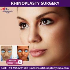 Looking for Best rhinoplasty surgeon in Delhi, India? We at cosmetic plastic surgery clinic, provide Nose Surgery at affordable cost/ price in Delhi, india by top plastic surgeon doctor - Dr. Ajaya Kashyap at KAS Medical Center. 

Call now on +91-9958221982 to get instant appointments and take the opportunity to avail knowledgeable consultation of Dr. Ajaya Kashyap 

Email: info@bestrhinoplastyindia.com
Web: www.bestrhinoplastyindia.com
Book video call consultation please call/WhatsApp: +91-9958221982, 9958221983

#nosejob #rhinoplasty #plasticsurgery #nosejobdelhi #nosereshaping #beauty #realself #tipnose
