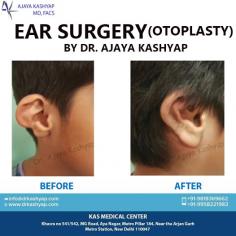 Ear surgery creates a natural shape, while bringing balance and proportion to the ears and face. Correction of even minor deformities can have profound beneﬁts to appearance and self-esteem.
For more information about otoplasty/ear reconstruction surgery, or to schedule a consultation, please call Dr. Ajaya Kashyap Clinic (KAS Medical Center) today at +91-9818369662, 9958221983 or use our online appointment request form.

E-mail: info@drkashyap.com
Whatsapp: +91 9289988888 (Whatsapp only)
Web: www.drkashyap.com
Youtube Video Link: https://www.youtube.com/watch?v=jpN73o71AuI

#Otoplasty​ #EarReconstruction​ #CosmeticSurgeryIndia​ #EarReshaping​ #DrKashyap
