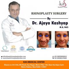 Rhinoplasty more commonly known as a nose job, is a cosmetic surgical procedure done on the nose. It can be purely cosmetic, or it can be reconstructive and done to correct a nasal problem. Contact us today inquire about rhinoplasty surgery cost in Delhi.

Schedule a consultation by:

Dr. Ajaya Kashyap
Web: www.bestrhinoplastyindia.com
Call: +91-9958221982
For Pricing: Text +91-9958221982
Location: Khasra no 541/542, MG Road, Aya Nagar, Metro Pillar 184, Near the Arjan Garh Metro Station, New Delhi, India

#nosejob #rhinoplasty #plasticsurgery #nosejobdelhi #nosereshaping #realpatient #beauty #realself #tipnose #cosmeticsurgery
