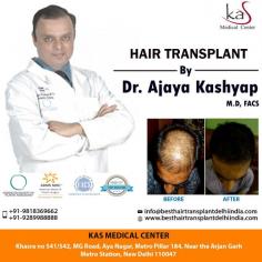 If you want a long term and permanent solution for your baldness, consider hair transplant surgery. Consult your plan for Hair Transplant surgery with our US Board Certified Surgeon via appointment.
EMI Available Pay Easy Monthly Instalments

Schedule a virtual consultation by:
Phone: 995-822-1982
For Pricing: Text 995-822-1982
Website: www.besthairtransplantdelhiindia.com
Location: Khasra no 541/542, MG Road, Aya Nagar, Metro Pillar 184, Near the Arjan Garh Metro Station, New Delhi, India
Note: Individual results may vary.⁣

OUR PATIENT FROM:-
#USA, #UK, #Canada, #Australia, #NewZealand, #Nigeria, #Kenya, #Ethiopia, #Uganda, #Tanzania, #Zambia, #Congo, #SriLanka, #Bangladesh, #Afghanistan, #Nepal, #Uzbekistan

#HairTransplant #FUE #FUT #HairLoss #PRP #Beard #Moustaches #Eyelash #Eyebrows #PlasticSurgery #traveling #Hair #Travel #MedicalTourism #Men #Women #EMI
