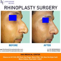 If you are thinking about getting a nose job, set up an appointment with your surgeon to discuss it. During that meeting, talk about your goals and tell the doctor what bothers you about your nose and how you would like to change it. Need Rhinoplasty (Nose Surgery) in Delhi, India. Meet Triple American Board Certified surgeon Dr. Ajaya Kashyap.
Dr. Kashyap has performed the Best Rhinoplasty Surgery in India, as seen in NAYA ROOP NAYI ZINDAGI SHOW (Extreme Makeover Show) telecasted on SONY TV in Year 2008. 

Schedule a consultation by:
Dr. Ajaya Kashyap
Email: info@bestrhinoplastyindia.com
Web: www.bestrhinoplastyindia.com
Call: +91-9958221982
For Pricing: Text +91-9958221982
Location: Khasra no 541/542, MG Road, Aya Nagar, Metro Pillar 184, Near the Arjan Garh Metro Station, New Delhi, India

#nosejob #rhinoplasty #plasticsurgery #nosejobdelhi #nosereshaping #realpatient #beauty #realself #tipnose #cosmeticsurgery
