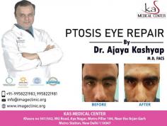 Ptosis surgery is an operation to tighten the muscle that lifts your upper eyelid. If you are thinking about getting a Ptosis Eye Repair, set up an appointment with Dr. Ajaya Kashyap to discuss it.

Schedule a consultation by:
Dr. Ajaya Kashyap
Call or Whatsapp: 9958221981
Email: info@imageclinic.org
Website: www.imageclinic.org
Location: Khasra no 541/542, MG Road, Aya Nagar, Metro Pillar 184, Near the Arjan Garh Metro Station, New Delhi, India

#PtosisRepair #PtosisEyeRepair #droopyeyelid #UpperEyelidLift #EyelidLift #CosmeticSurgery #CosmeticSurgeon #PlasticSurgery #PlasticSurgeon #DrKashyap
