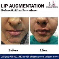 If you do not come by full lips naturally then lip augmentation might be a solution to your less defined lip problem. When a patient opts for injectable filler the procedure will be done on an outpatient basis and it will be done under local anesthesia. There are many different types of injectable fillers, cosmetic fillers or autologous fat filler that can be used for the lips.

Interested? Call to make an appointment (995) 822-1982
Visit: www.bestfacesurgeryindia.com


#lipaugmentation #lipaugmentationcost #lipenhancement #lipenlagermentsurgeon #fattransfer #filler #fillercost #cosmeticsurgery #plasticsurgery #drkashyap


