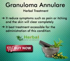 Herbal Treatment for Granuloma Annulare skin condition that is characterized by raised reddish skin bumps arranged in the pattern of a ring. Granuloma annulare usually affects the hand or feet.
https://www.herbal-care-products.com/blog/best-way-to-treat-granuloma-annulare-naturally-at-home/