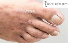 Better known as Eczema, at Safe Health & Med Spa Dermatology, we provide the latest treatments for those with Atopic Dermatitis. Our doctors can educate patients on techniques to help improve eczema & find relief. For more information, visit our website.
