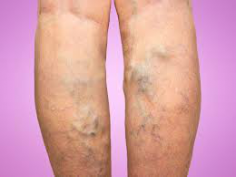 When people have a dietary deficiency or loose skin elasticity, it may play a major role in the occurrence of varicose veins. When you age, the vein walls in the legs lose most of their strength and muscle tone. Veins begin to grow and weaken leading to blood pooling in the lower legs and ankles. 
